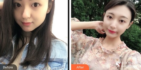 重庆爱德华医院整形美容中心罗慧玲整形价格表附埋线提升案例展示